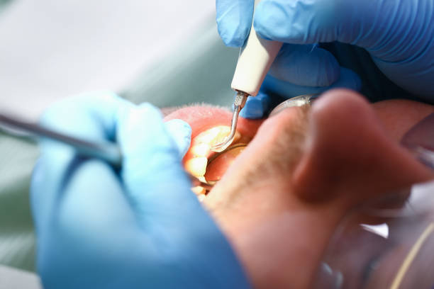 Best Emergency Root Canal Treatment in Myersville, MD